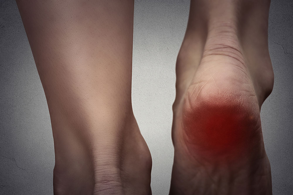 Causes and Treatment of Fibromyalgia Foot Pain