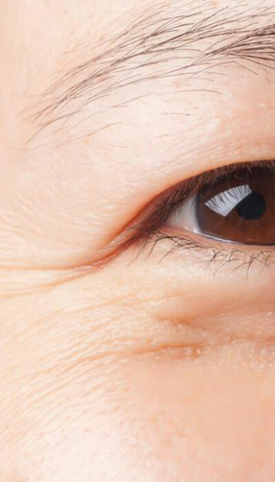 Causes of Under Eye Bags and Their Treatments