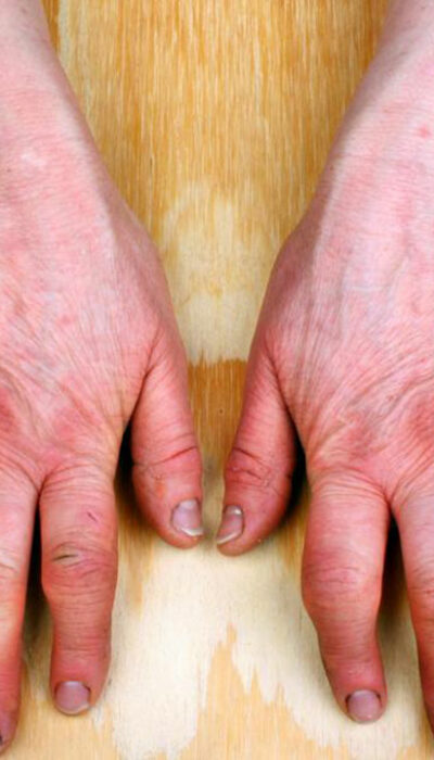 A Brief Overview of Rheumatoid Arthritis