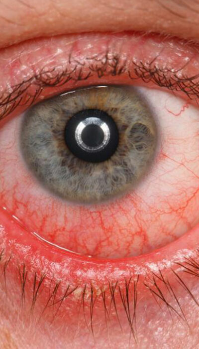 A Few Common Symptoms, Causes, And Treatments of Pink Eyes