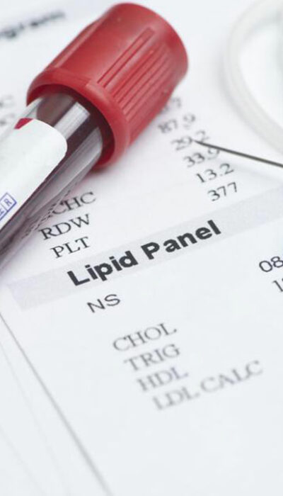 A Few Essential Things to Know about Lipoprotein Profile