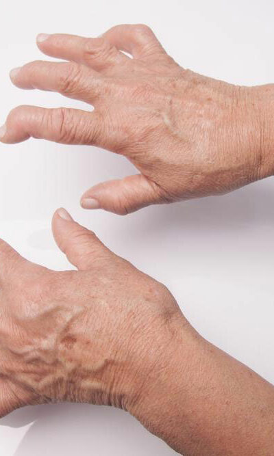 A Quick Guide of Rheumatoid Arthritis Drugs