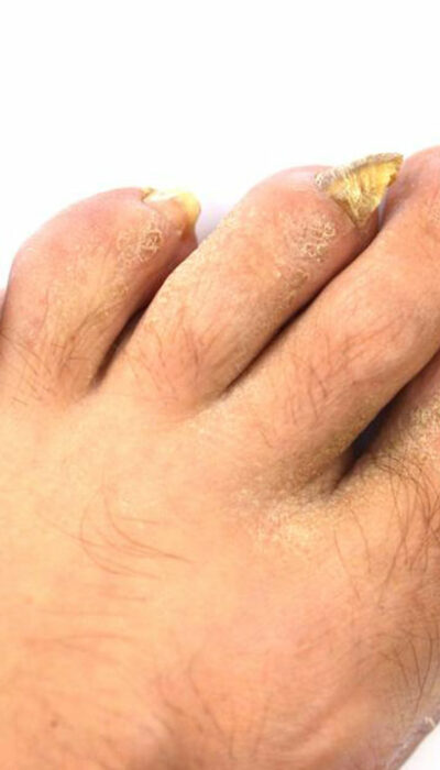 An Effective Way to Treat Toenail Fungus &#8211; Hydrogen Peroxide