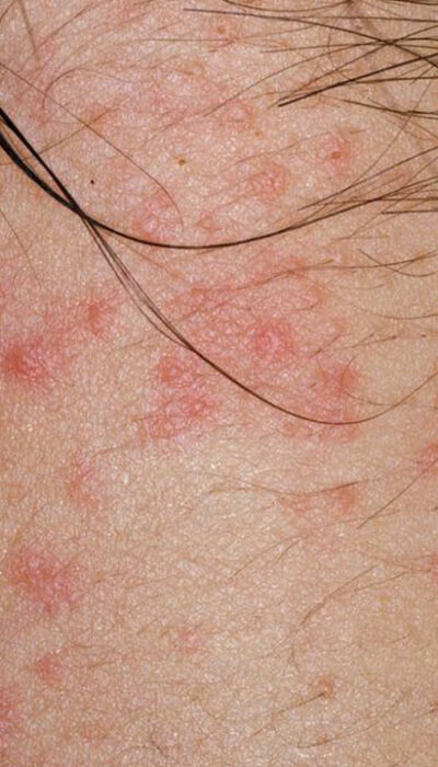 An Introduction to the Types of Itchy Skin Rashes