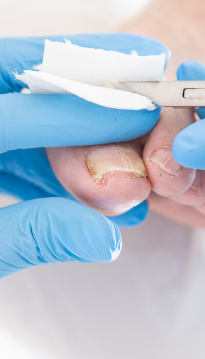 All About Toenail Fungus