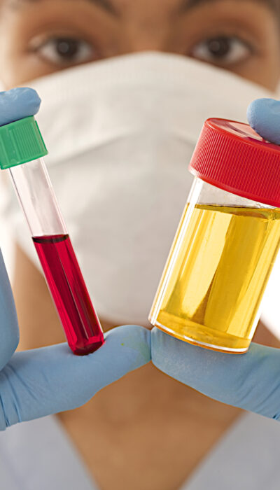 All You Need To Know About Blood In Urine