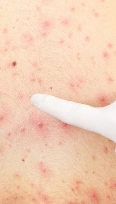 All You Need to Know About Pityriasis Rosea Treatments