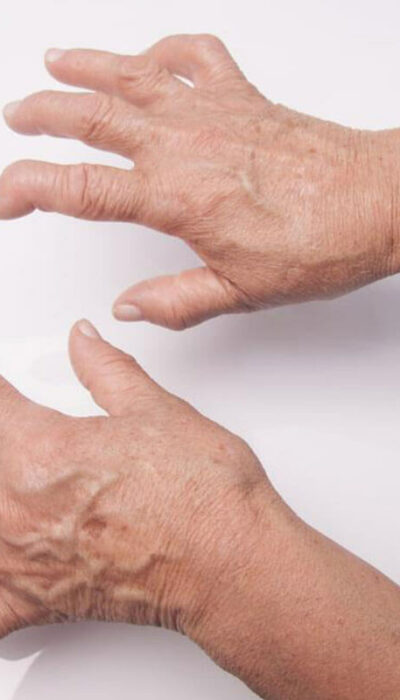 All You Need to Know About the Diagnosis of Rheumatoid Arthritis