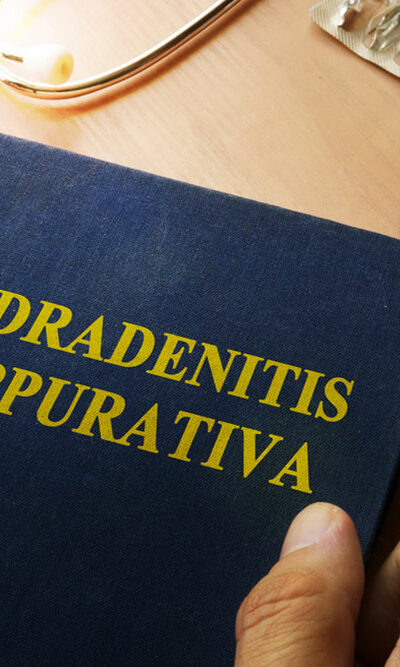 All You Need to Know about Hidradenitis Suppurativa