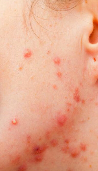 All You Need to Know about Rosacea Skin Disorder