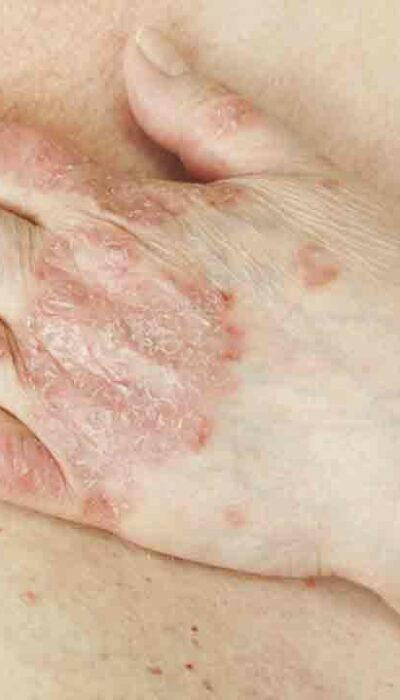 All the Information on Psoriasis You Need to Know