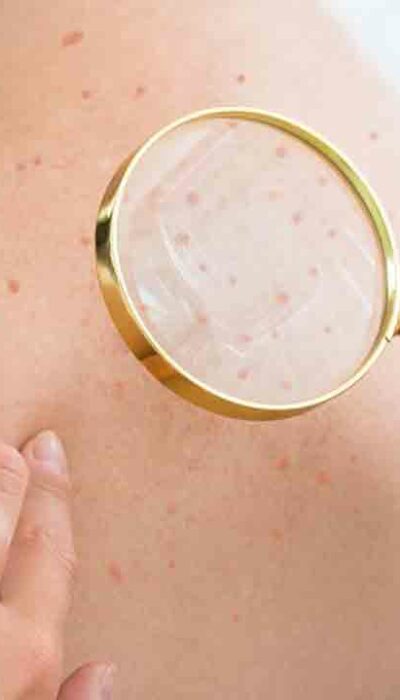 Atopic Dermatitis Eczema &#8211; Causes, Symptoms, and Treatments