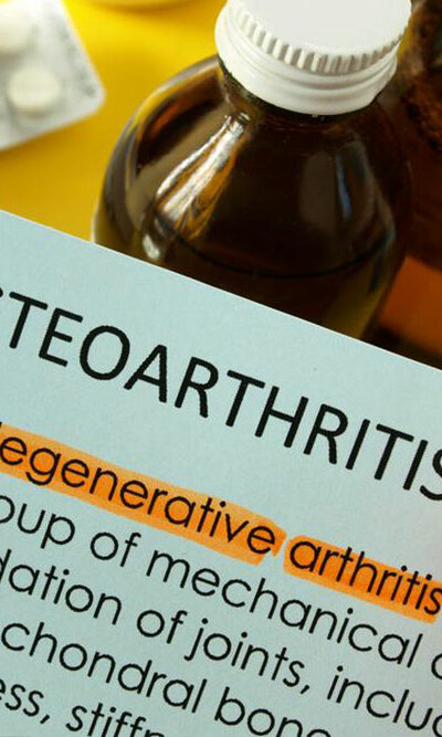 Best Treatment Options for Osteoarthritis of the Knee