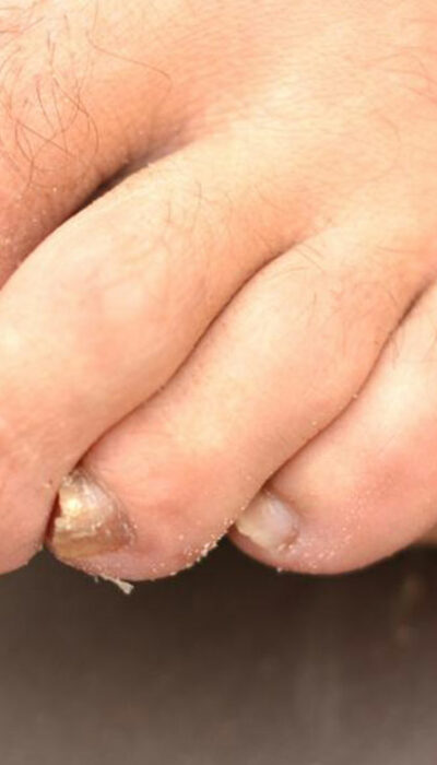 Get Rid of Toenail Fungus Quickly with 6 Home Remedies