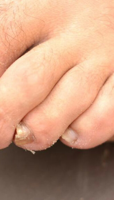 Get rid of toenail fungus with these home remedies