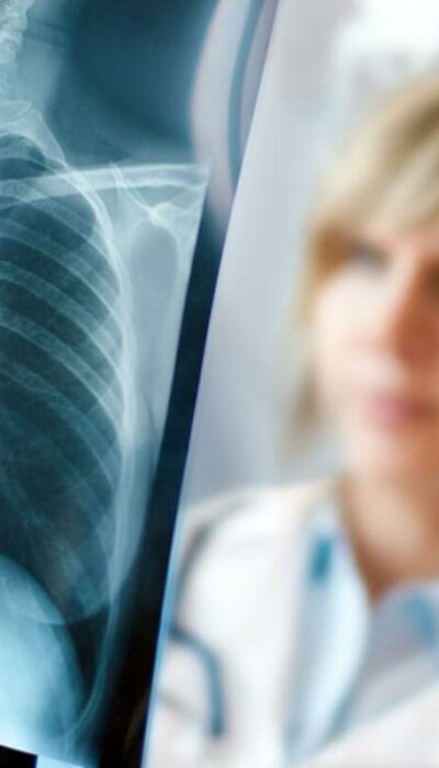 Do Not Ignore These Lung Cancer Symptoms