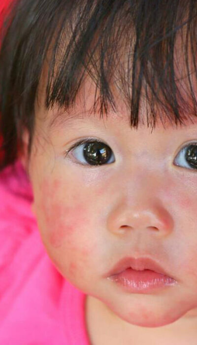 Do Not Neglect These Child Allergy Symptoms