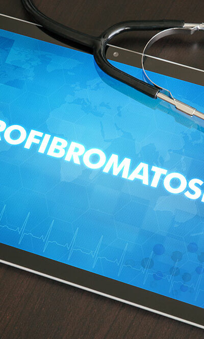 Doctor-recommended treatments for neurofibromatosis