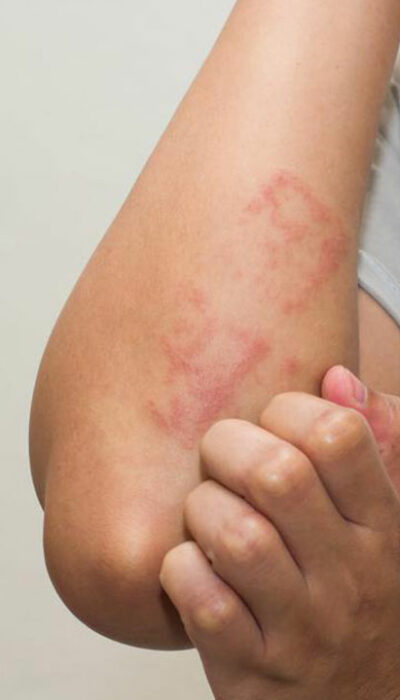 Dietary Changes and Tips to Cure Shingles Rash