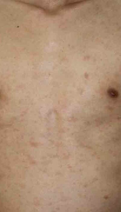 Different Types of Pityriasis Rosea Treatments