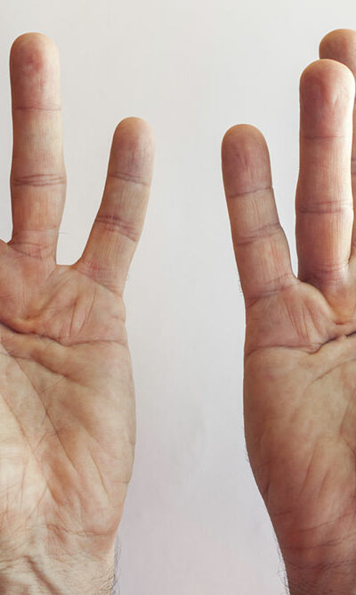 Dupuytren’s Contracture &#8211; Its Symptoms and Causes