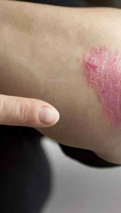 Easy Treatment Options to Cure Psoriasis