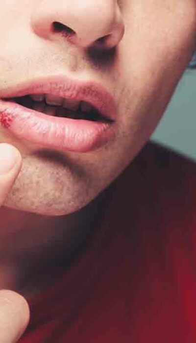 Effective Home Remedies for Treating Cold Sores