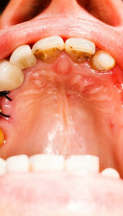 Effective Home Remedies to Treat Cavities