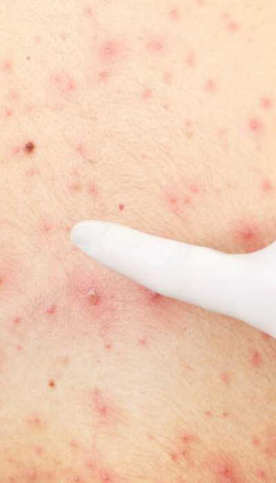 Effective Remedies for Treating Skin Rashes