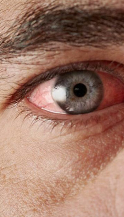 Effective Treatment Methods for Curing Red-eye