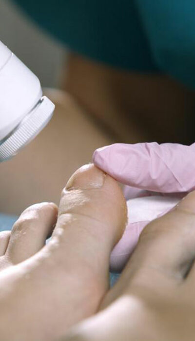 Essential Facts about Nail Fungus Cure