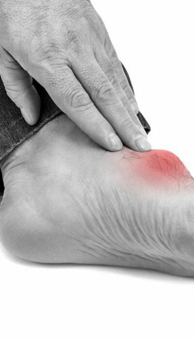 Everything You Need to Know About the Best Gout Treatments