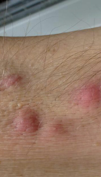 Everything You Need to know About Hidradenitis Suppurativa