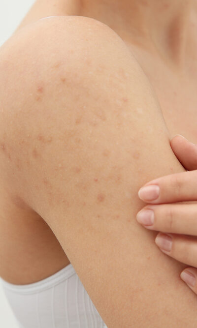 Everything You Need To Know About Hiv Skin Rash