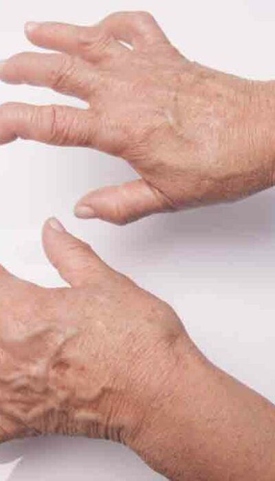 Food Items You Should Avoid When Suffering from Arthritis