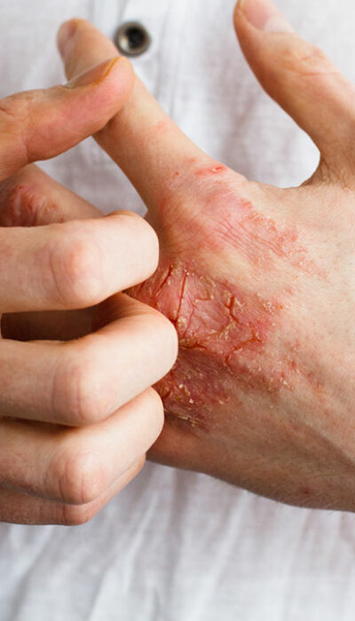 Foods to Eat and Avoid for Patients with Eczema