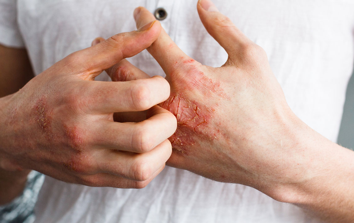 Foods to Eat and Avoid for Patients with Eczema