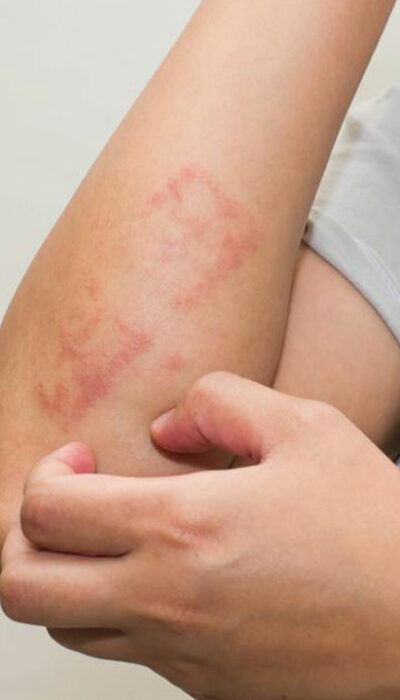 Factors Causing Atopic Dermatitis and Treatments for it