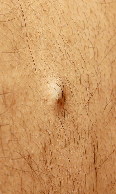 Facts and Signs of Ingrown Hair