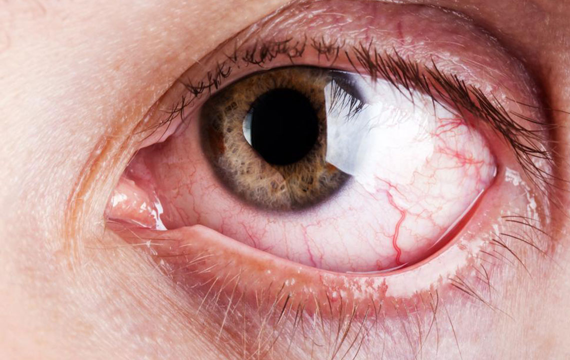 Few Vital Causes and Cure of Chronic Dry Eye