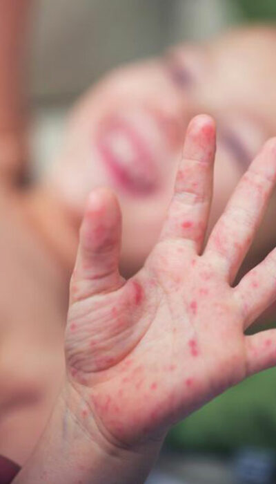 Find the Cure for Baby Eczema with the Right Creams