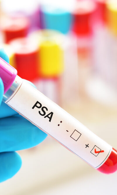 Know About Psa Levels And How To Lower Them