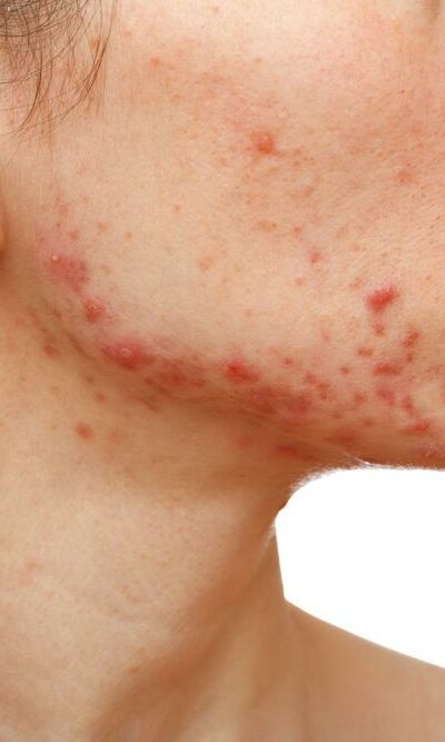 Know About The Symptoms Of Different Types Of Eczema