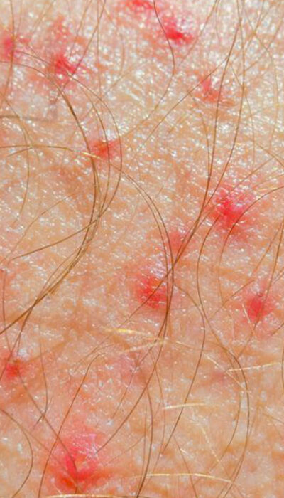 Know Everything about Atopic Dermatitis