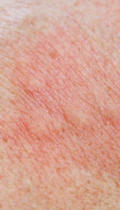 Know about the 5 Types of Skin Rashes