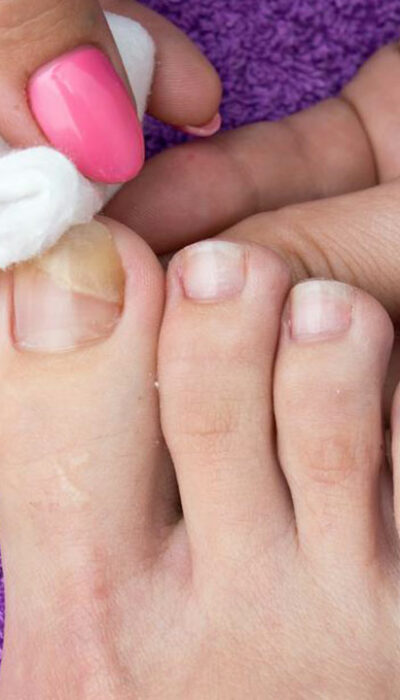 Know about the Top 5 Nail Fungus Cures