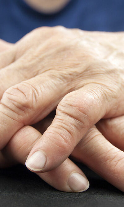 Know about the stages, diagnosis, and prevention of arthritis