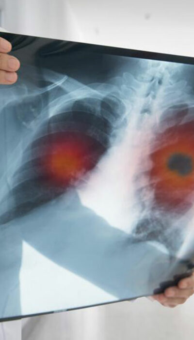 Know the causes, symptoms, and treatment of non-small cell lung cancer