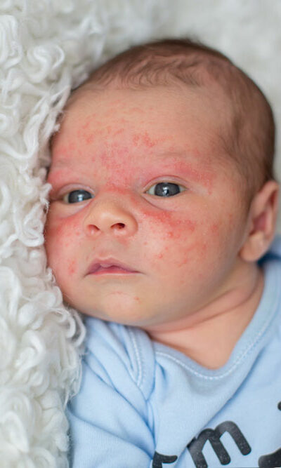 How Baby Eczema Differs With Age and Steroid Treatment