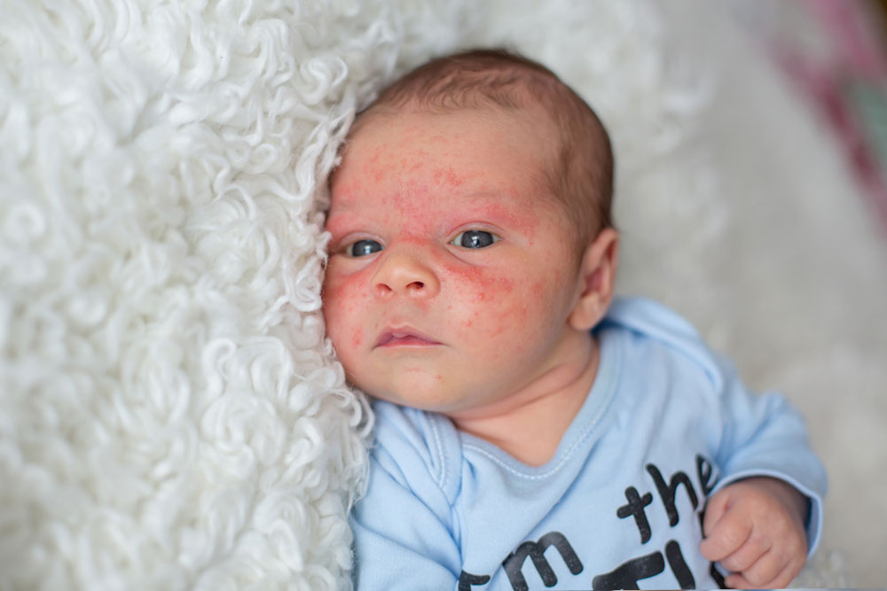 How Baby Eczema Differs With Age and Steroid Treatment